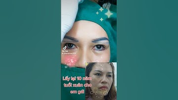 Nâng cung chân mày dưới + cắt mí mắt dưới/Thẩm Mỹ Thành Công #thanhcongtieuphau