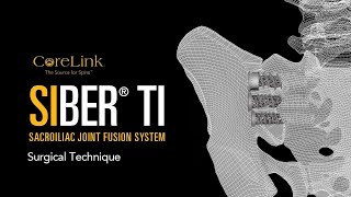 CoreLink Siber Ti Sacroiliac Joint Fusion System Procedure