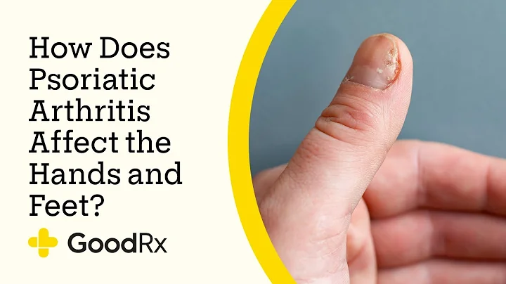 How Does Psoriatic Arthritis Affect the Hands and Feet? | GoodRx