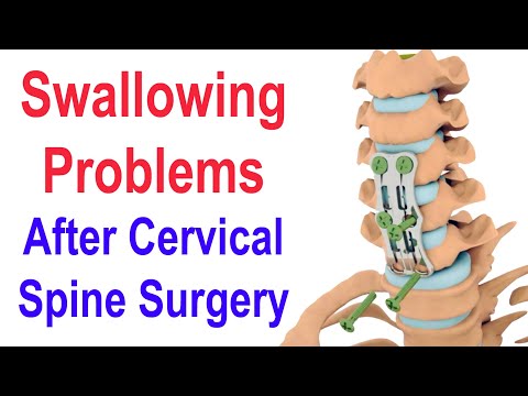 Swallowing Problems after Cervical Spine Surgery (ACDF)