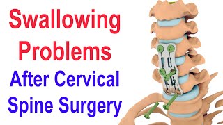 Swallowing Problems after Cervical Spine Surgery (ACDF)