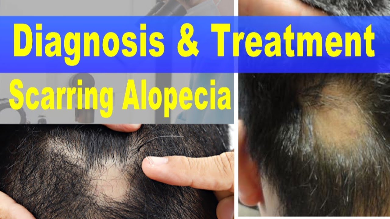 Diagnosis & Treatment Scarring Alopecia Dr. Mukesh Aggarwal YouTube