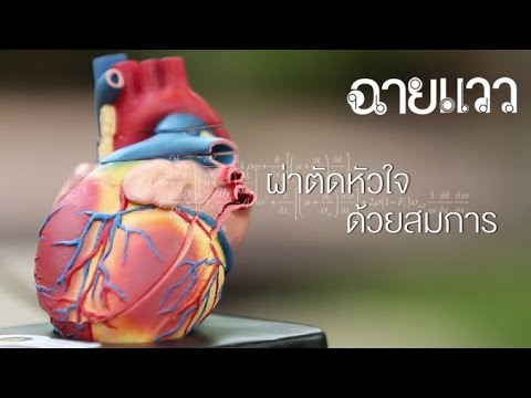 ฉายแวว [by Mahidol] ผ่าตัดหัวใจด้วยสมการ