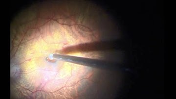 Macular Hole - Retinal Massage & Visco Plug