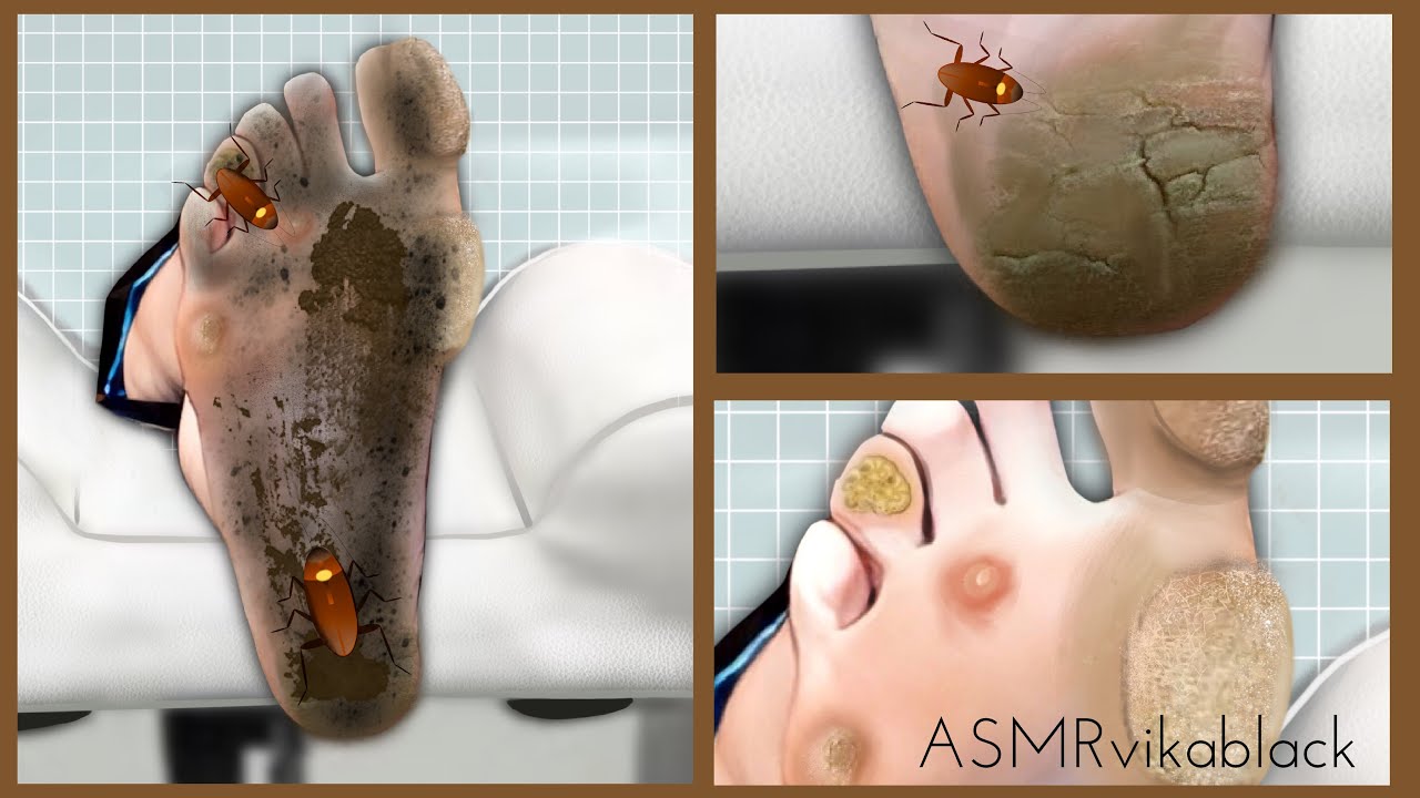 ASMR Surgery to Remove Large Plantar Warts Animation Corn Foot