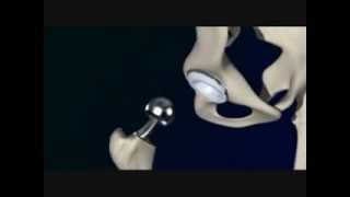 Clip - Prótese Total De Quadril Artroplastia