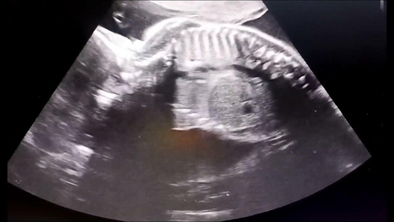 〽️ 𝐬𝐚𝐜𝐫𝐨𝐜𝐨𝐜𝐜𝐲𝐠𝐞𝐚𝐥 𝐭𝐞𝐫𝐚𝐭𝐨𝐦𝐚.