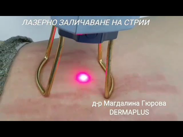 Лазерно заличаване на стрии в Пловдив