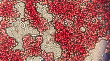 Como começa a Elefantiase?