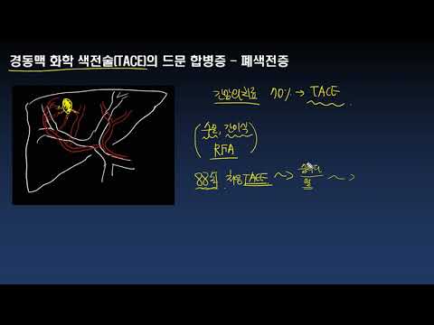 경동맥화학색전술(TACE)의 드문 합병증 - 폐색전증