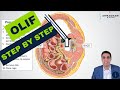 OLIF (Oblique Lateral Interbody Fusion) - Procedure details, recovery expectations and more!