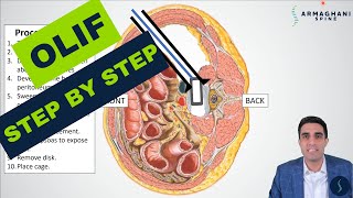 OLIF (Oblique Lateral Interbody Fusion)  Procedure details, recovery expectations and more!