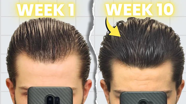 My Crazy 2.5 Months on FINASTERIDE, MINOXIDIL and ...