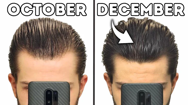 My Crazy 2.5 Months on FINASTERIDE, MINOXIDIL and ...