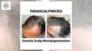 Scalp Micropigmentation (SMP) Density Hair Tattoo, no more Toppik hair powders