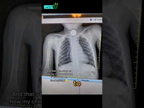 طفل بلع عملة معدنية