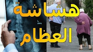 هشاشة العظام | الأسباب | العلاج | الموسوعة العلمية