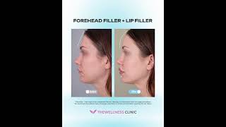 3D Side Profile Harmony: Forehead Filler + Lip Filler ✨ Soft Curves & Defined Volume screenshot 5