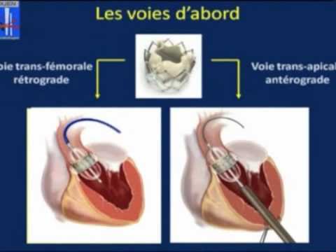 KEPHALIOS annonce une première implantation de Kalios, son dispositif  innovant de réparation de la valve mitrale