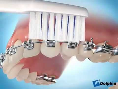 როგორ მოვუაროთ ბრეკეტებს ?