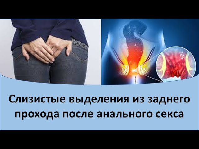 Шишка рядом с анальным отверстием - Проктология - 13 мая - Здоровье Mail Шишка рядом с анальным отверстием - Проктология - 13 мая - Здоровье Mail