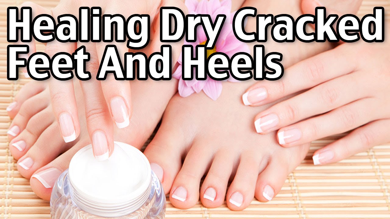 Healing Dry Cracked Feet And Heels - YouTube