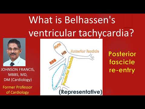 Video: Ce este tahicardia ventriculară fasciculară?