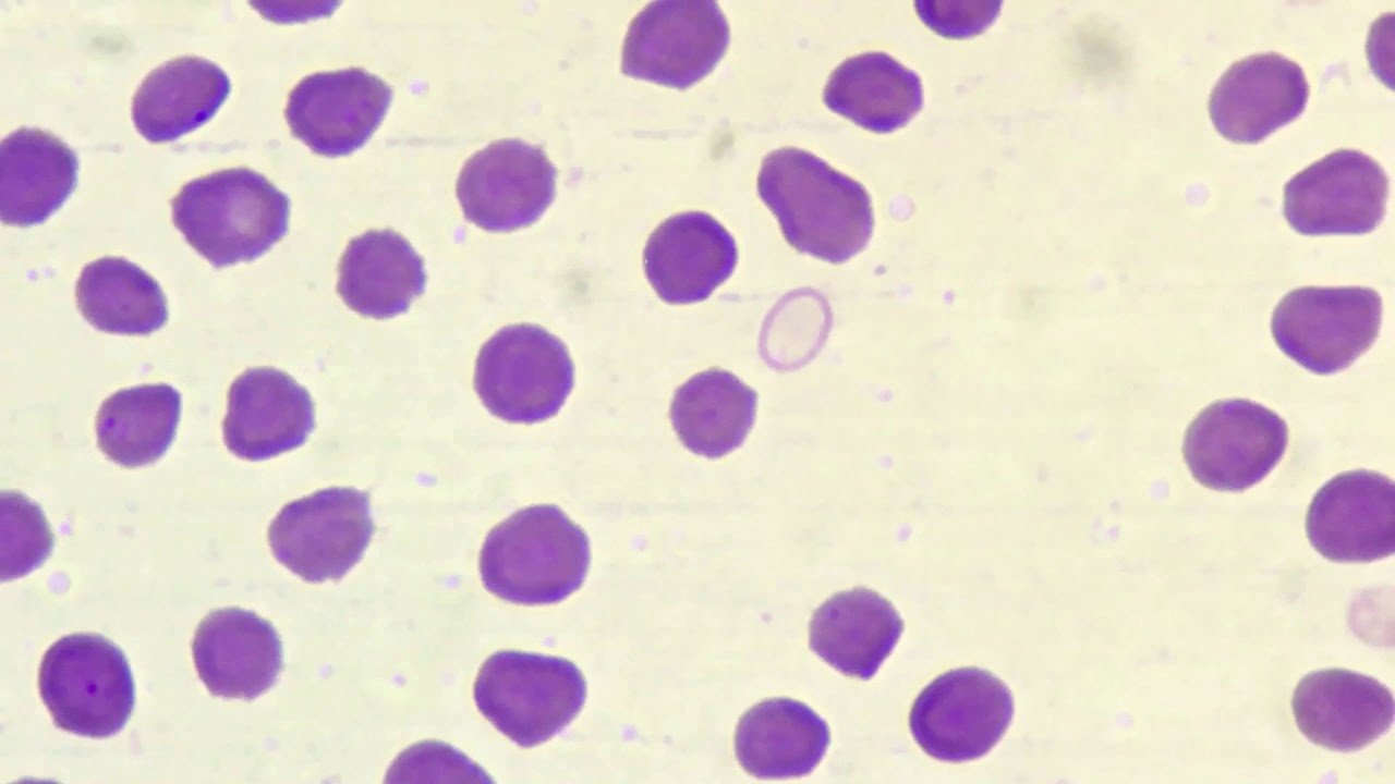 Red Blood Cell Morphology - Medicine LibreTexts