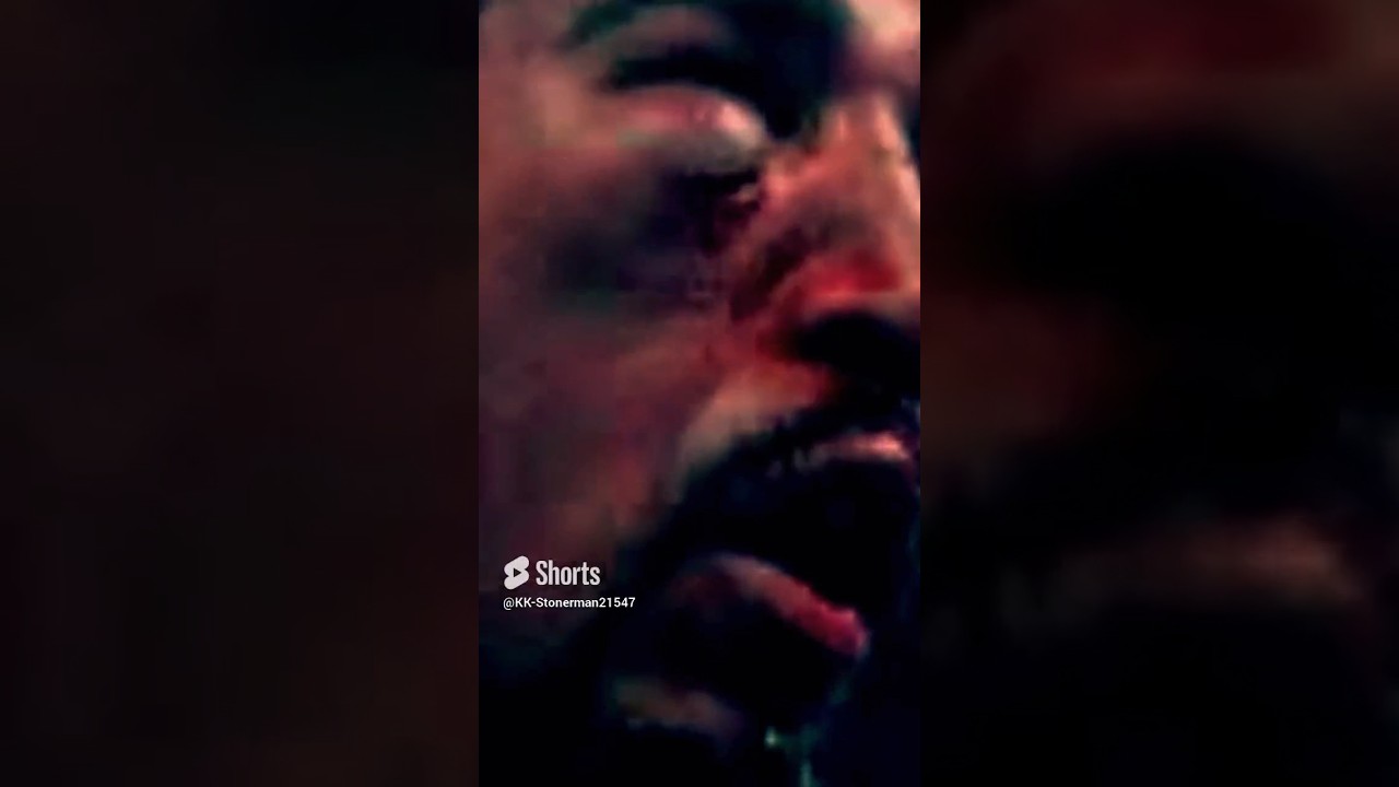 PacMan Fractures Margarito’s right eye orbital BONE