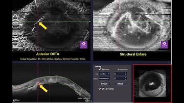 Corneal Neovascularization AS OCTA