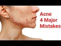 Wants to get rid of acne | Stop Doing These 4 Mistakes || Dr. Vivek