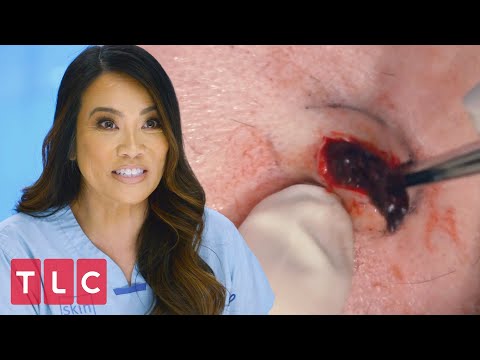 Dr. Lee Pops a BLUE Cyst! | Dr. Pimple Popper