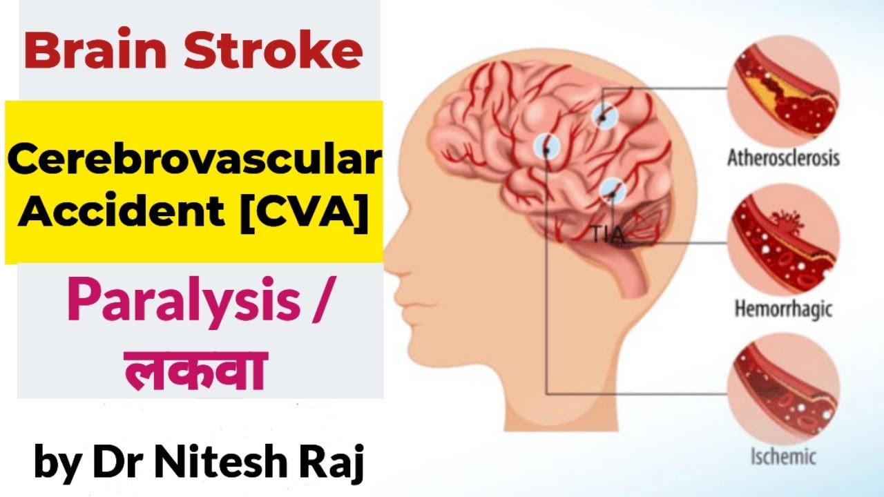 Stroke/Brain Stroke/Brain haemorrhage/Paralysis/लकवा #drniteshraj