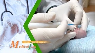 видео Интимная хирургия: мужское обрезание