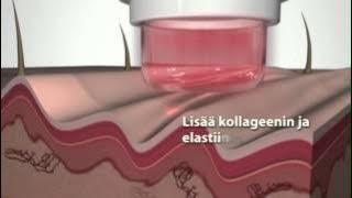 Download lagu DermaWand® - FI