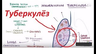 видео Этапы пневмонии: особенности и разновидности патологии