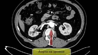 КТ брюшной полости (аневризма брюшной аорты)(http://symptominfo.ru/article/doc/29/ или http://symptominfo.ru/article/doc/126/ или http://www.medglobus.ru/Medarticles-Angiology-Aortic%20Aneurisma.htm или ..., 2012-01-30T20:26:57.000Z)