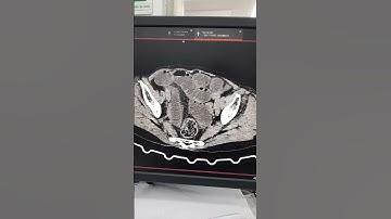 Tắc ruột non. Túi thừa D2 hành tá tràng.