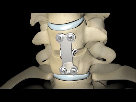 Back Surgery: Spinal Fusion