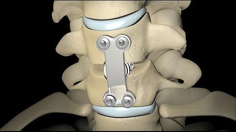 Spinal Fusion (2010)
