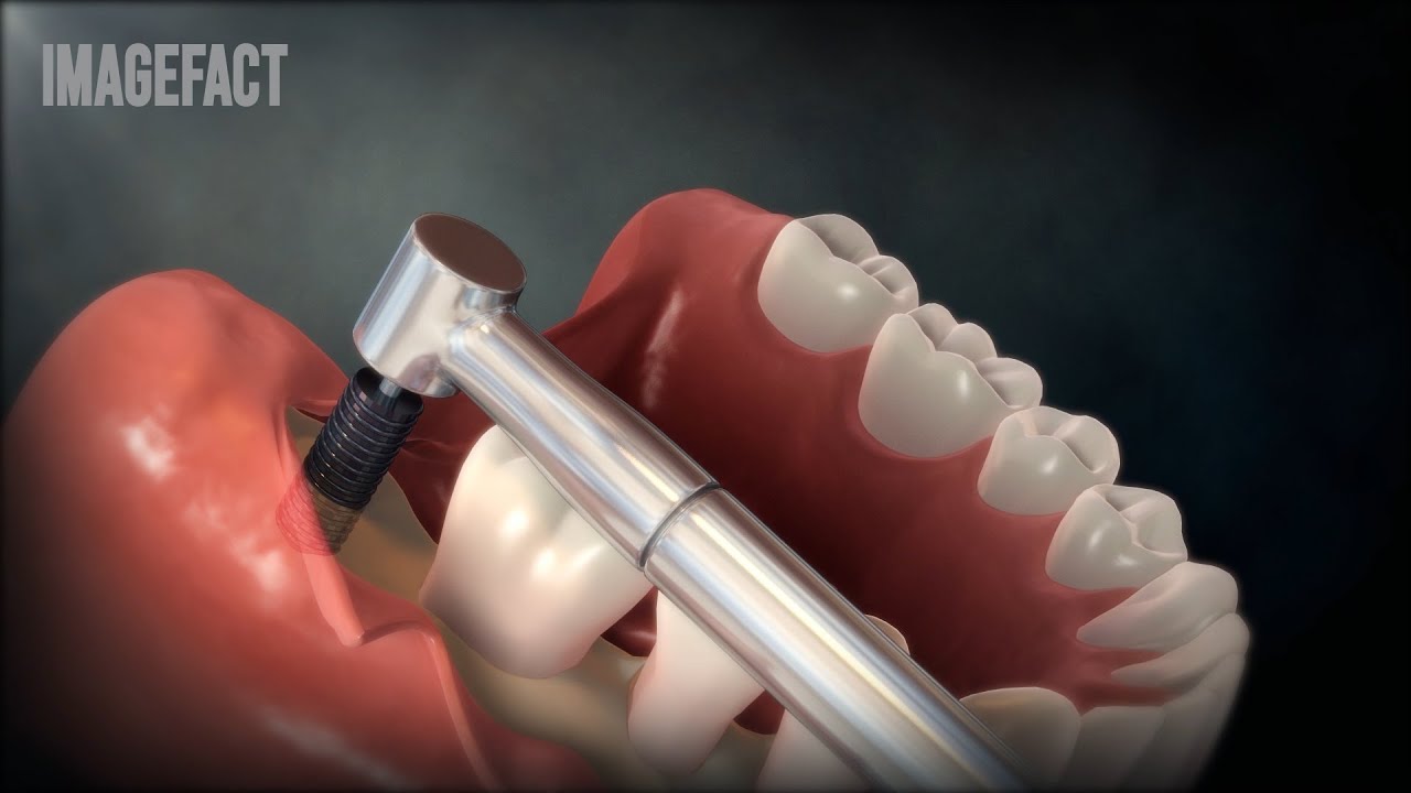임플란트 / Dental implant surgery YouTube
