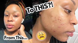 MY HORMONAL ACNE CAME BACK 😩 Journey To Clear Skin + How I've Been Treating Acne & Dark Marks by Kilahmazing 8,551 views 3 years ago 8 minutes, 53 seconds