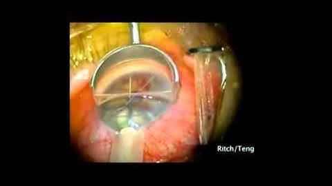 Ocular Ritch Panoramic Surgical Gonioprism