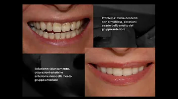 Cosa succede se si rovina lo smalto dei denti?