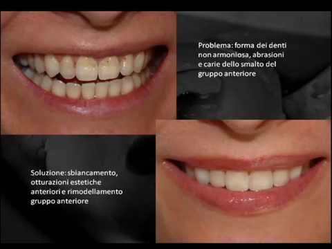 Video: Denti Neri: Smalto, Decadimento, Cause, Macchie E Trattamento