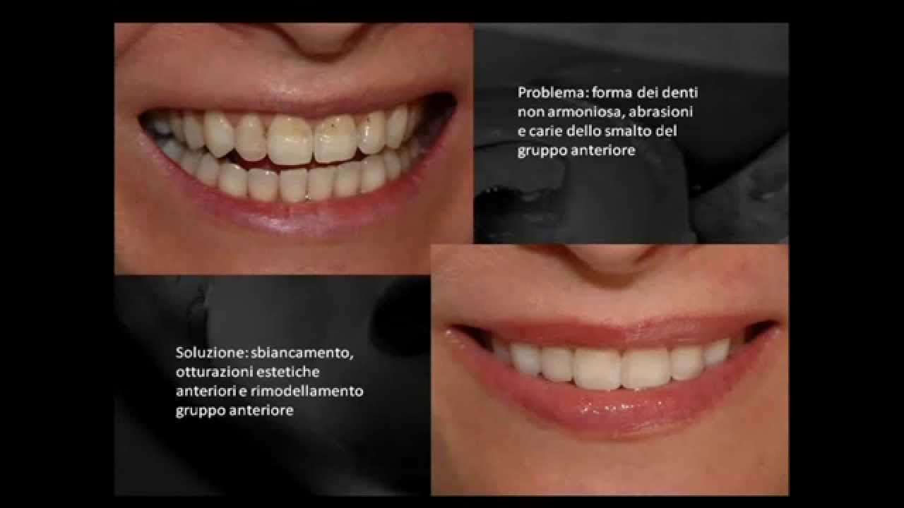 CORREZIONE DEI DIFETTI DELLO SMALTO