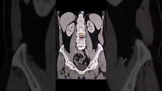 CT Colonography #foryou #radiographer #radiology #ctscan #colon #viral #fypシ #medicalstudent