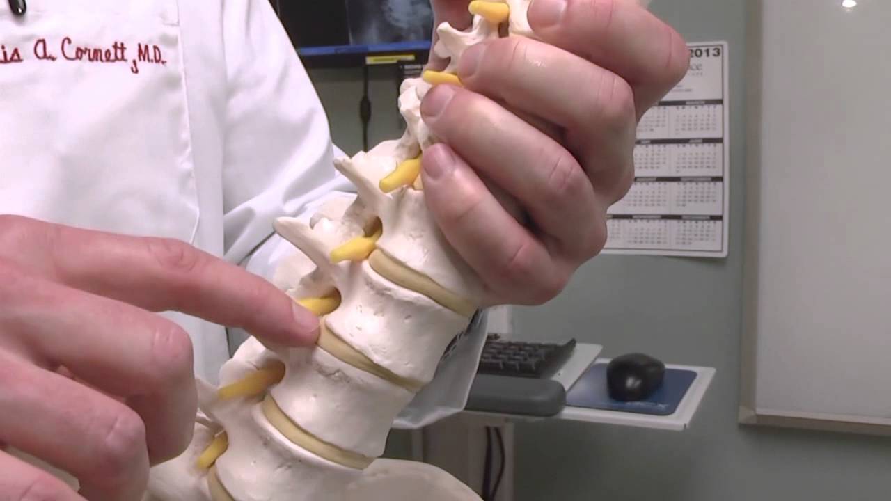 Ask UNMC Slipped Vertebrae YouTube