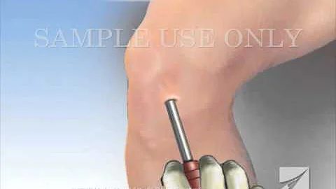 Knee Arthroscopy