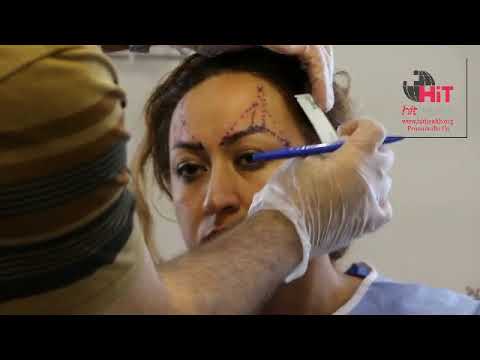 Eyebrow lifting with Double Needle 